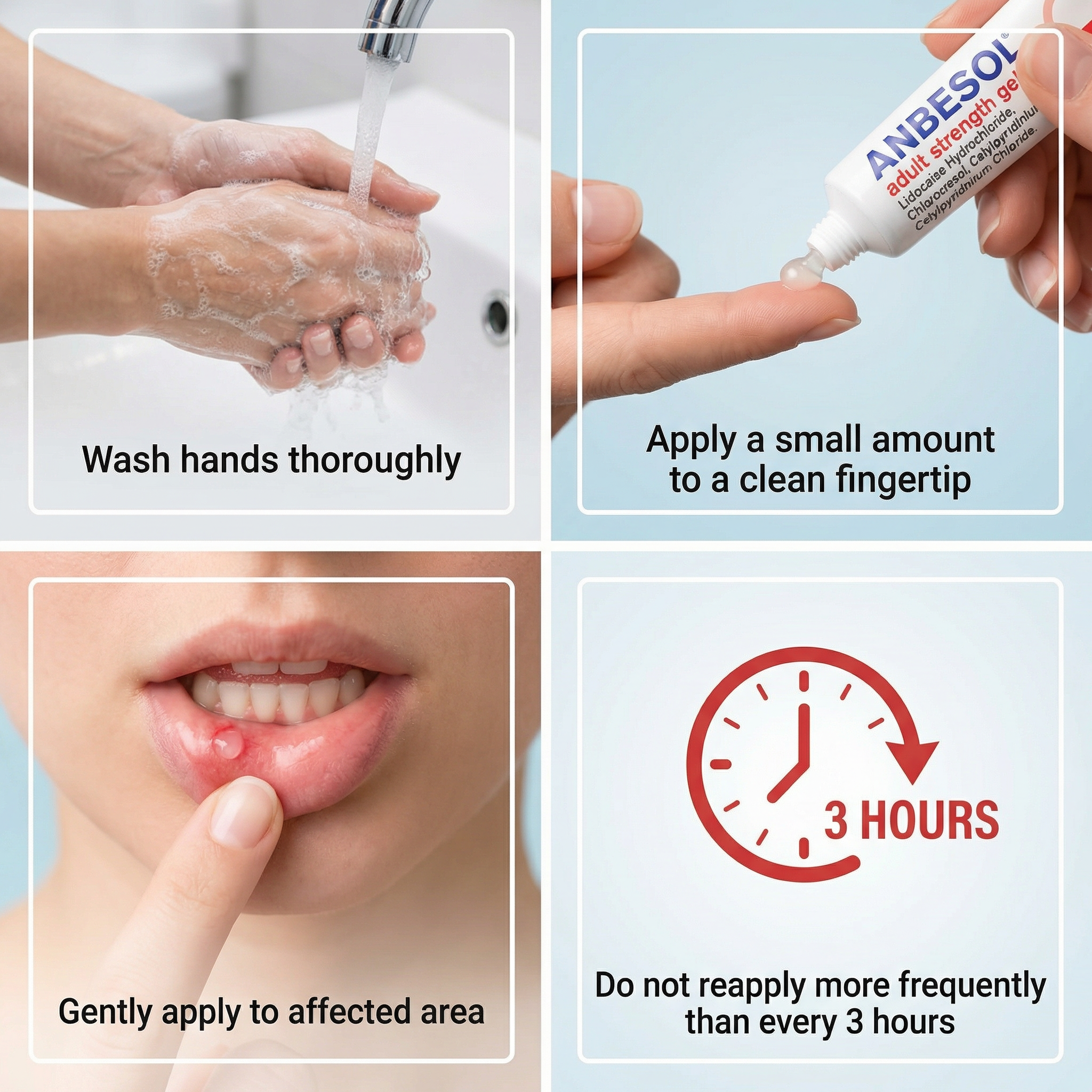 Anbesol Adult Strength Gel 10g